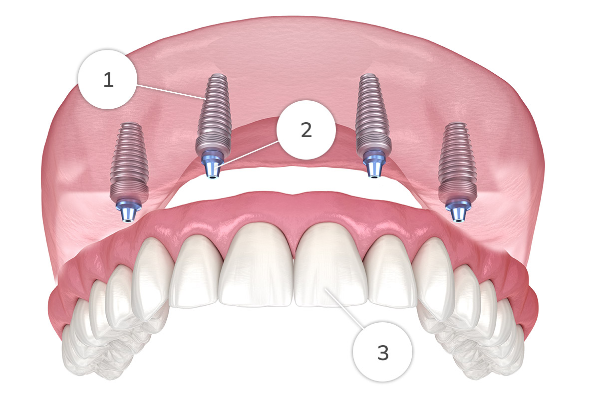 Fixed denture diagram