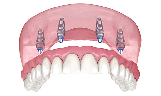 Fixed denture