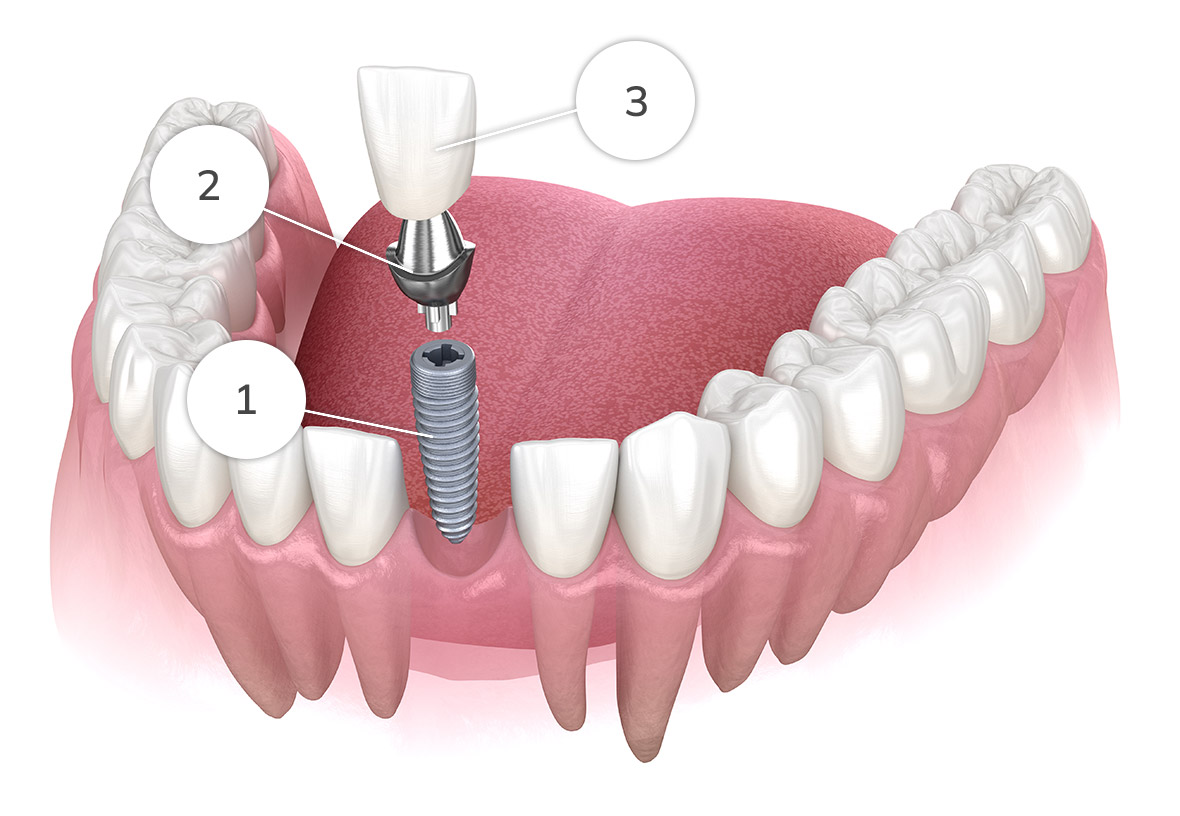 Single implant diagram