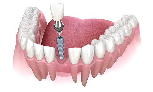 Single implant