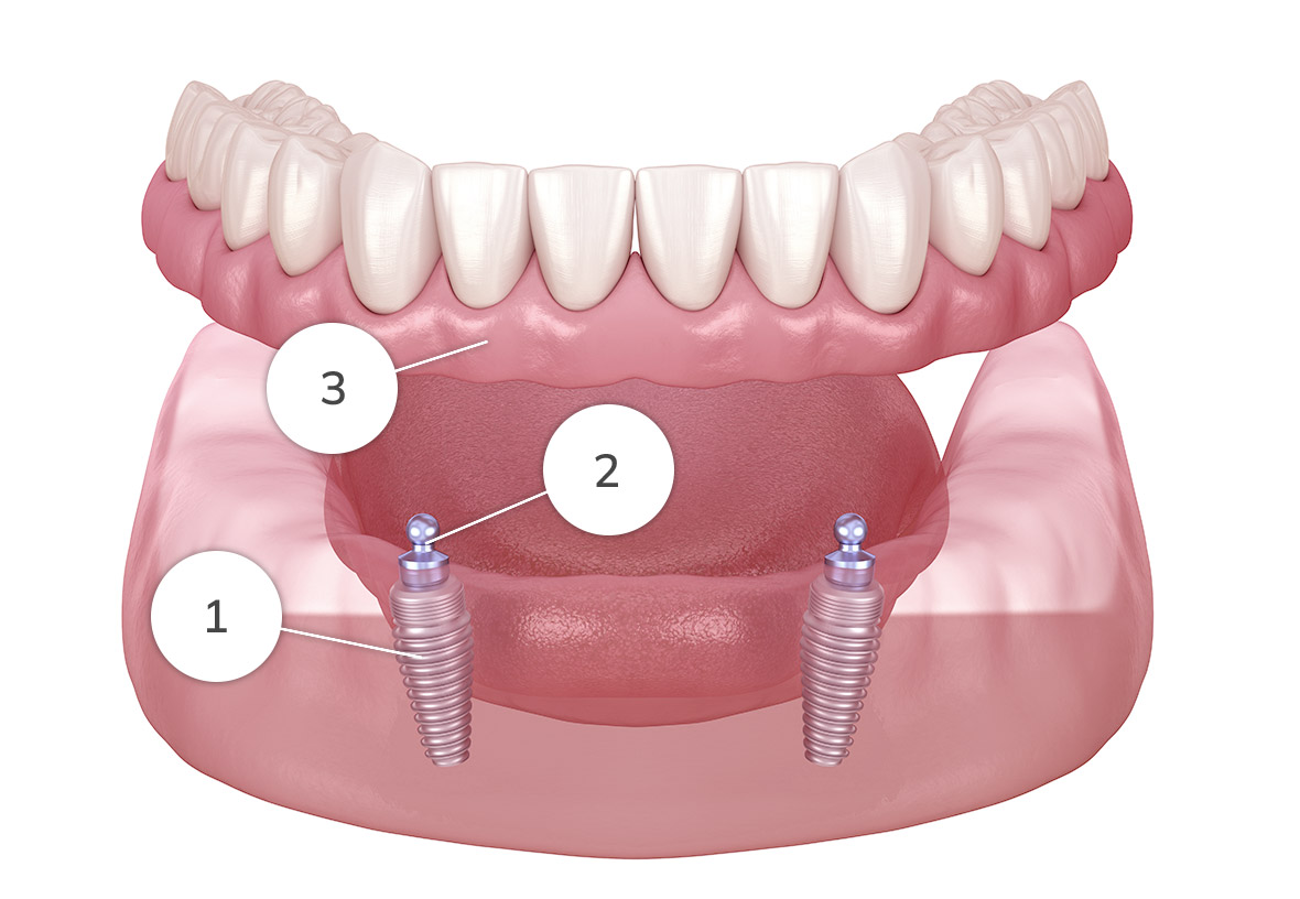 Implant supported denture diagram