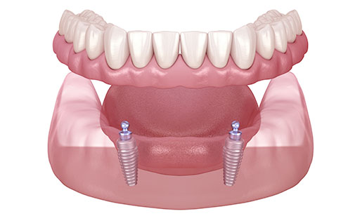 Implant supported denture