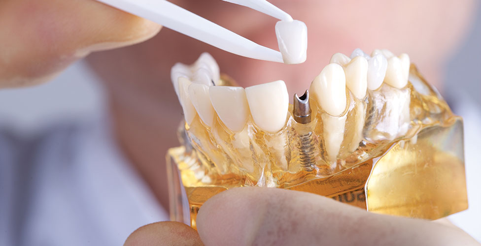 Dental Implants thumbnail
