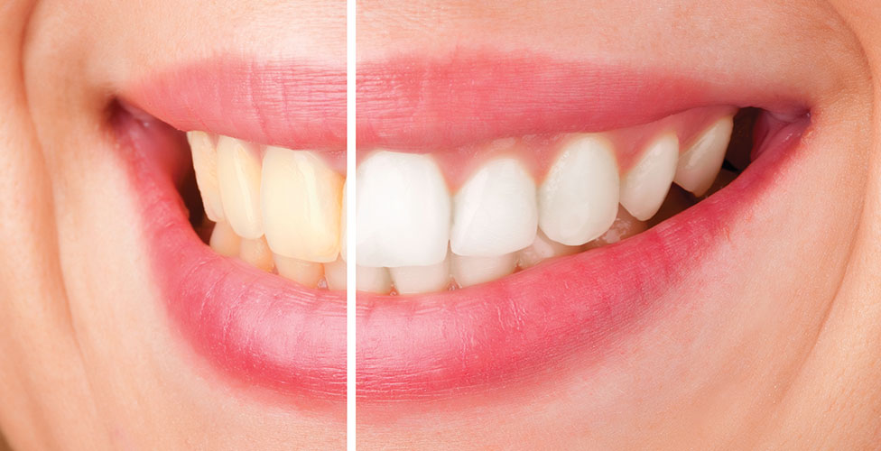 Teeth Whitening thumbnail